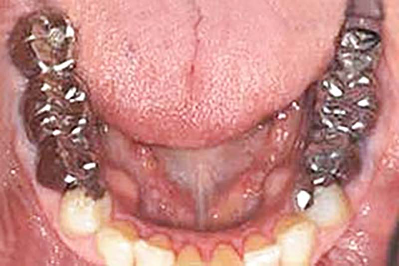 全体のむし歯痕(銀歯)と失った歯の審美治療前の写真