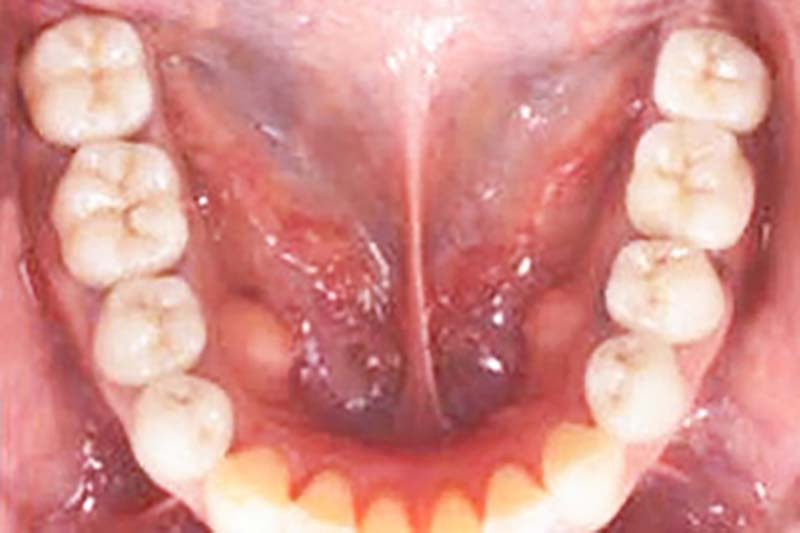 全体のむし歯痕(銀歯)と失った歯の審美治療後の写真