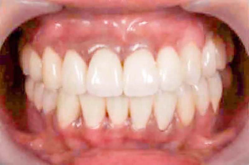 歯茎の腫れとむし歯痕(銀歯)の審美治療後の写真