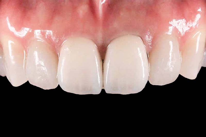 前歯の変色を白く綺麗にする審美治療後の写真