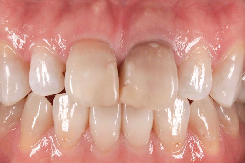 前歯の変色を白く綺麗にする審美治療前の写真