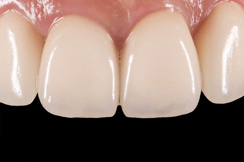 前歯の汚れと歯並びの審美治療後の写真
