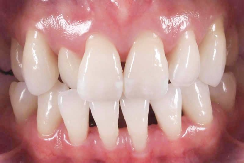 歯の向きと部分的な矯正治療前の写真