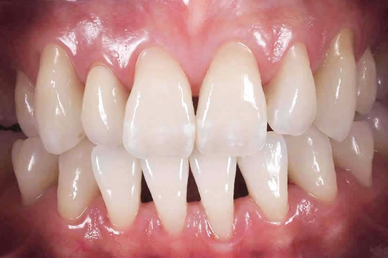 歯の向きと部分的な矯正治療後の写真