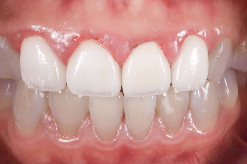 歯茎の腫れと被せ物不良の再治療前の写真