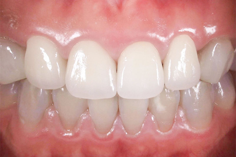 歯茎の腫れと被せ物不良の再治療後の写真
