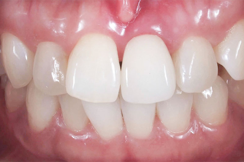 歯根の破損によるインプラント治療後の治療