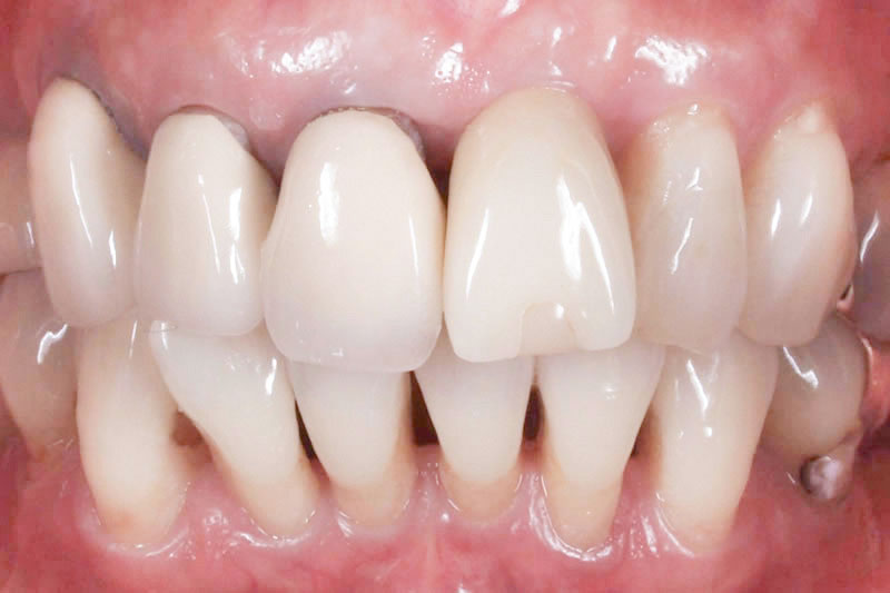 歯の根元の黒ずみ・歯並び・むし歯治療前の写真