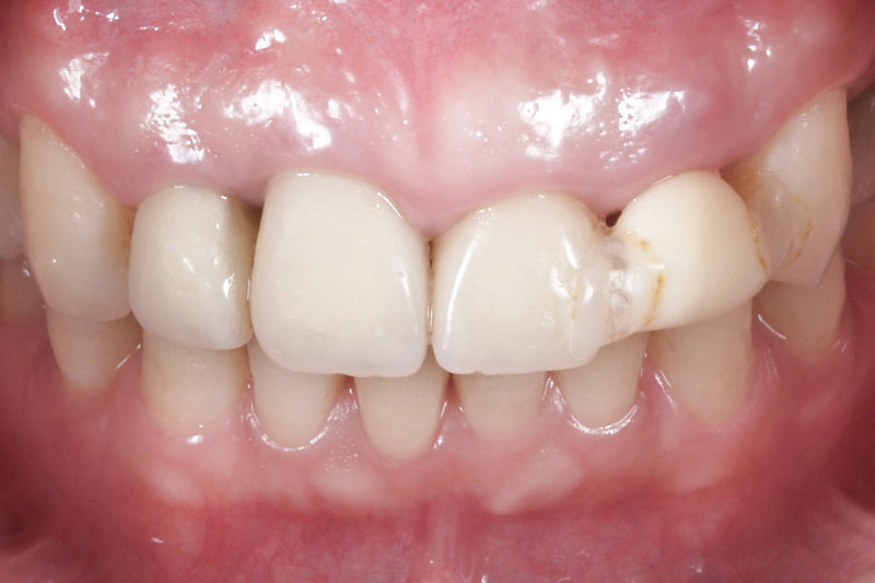 歯茎の高さと折れかけた歯を修復前の写真