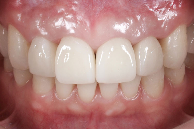 歯茎の高さと折れかけた歯を修復後の写真